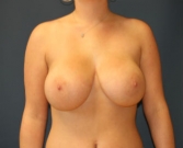 Feel Beautiful - Breast Augmentation San Diego Case 52 - After Photo